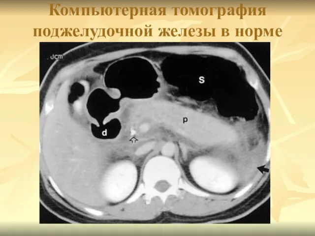 Компьютерная томография поджелудочной железы в норме