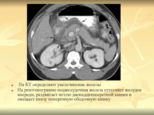 На КТ определяют увелечинение железы На рентгенограмме поджелудочная железа оттесняет желудок