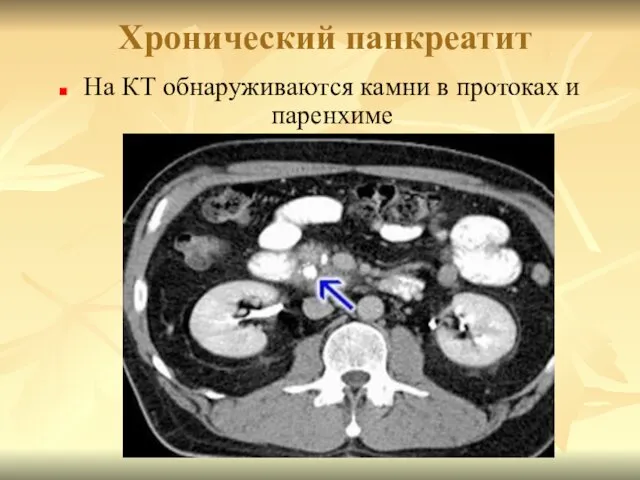 Хронический панкреатит На КТ обнаруживаются камни в протоках и паренхиме