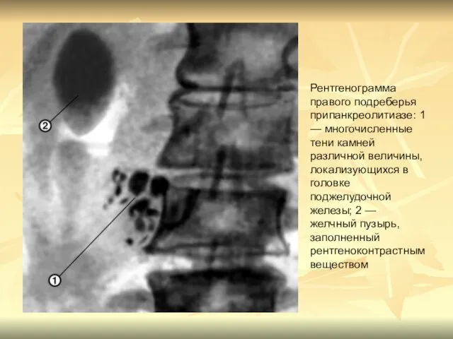 Рентгенограмма правого подреберья припанкреолитиазе: 1 — многочисленные тени камней различной величины,