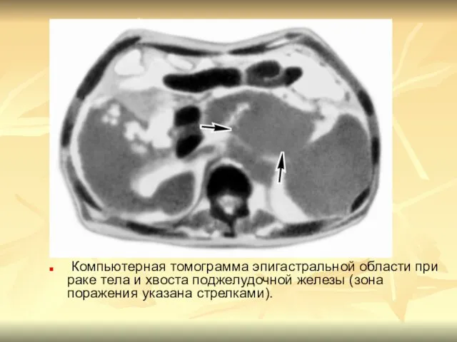 Компьютерная томограмма эпигастральной области при раке тела и хвоста поджелудочной железы (зона поражения указана стрелками).