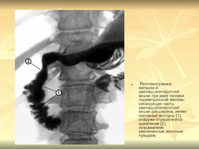 Рентгенограмма желудка и двенадцатиперстной кишки при раке головки поджелудочной железы: нисходящая