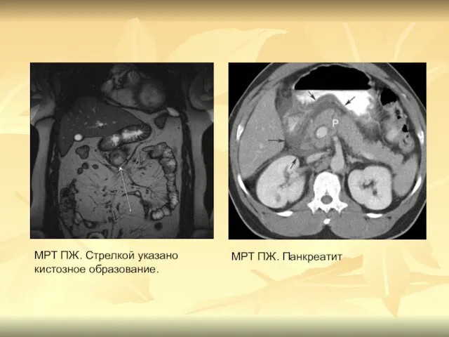 гг МРТ ПЖ. Стрелкой указано кистозное образование. МРТ ПЖ. Панкреатит