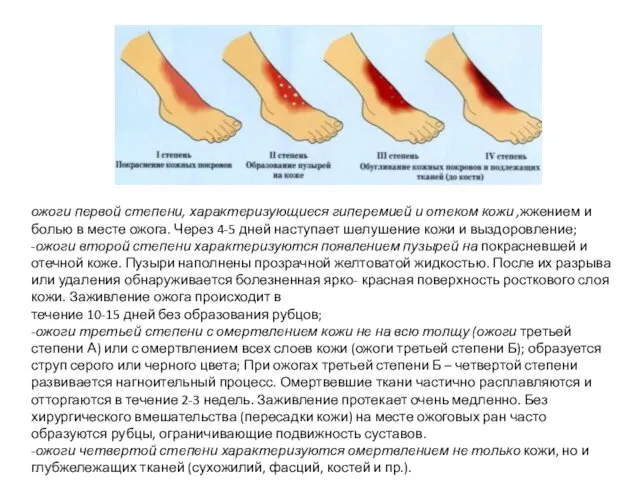 ожоги первой степени, характеризующиеся гиперемией и отеком кожи ,жжением и болью