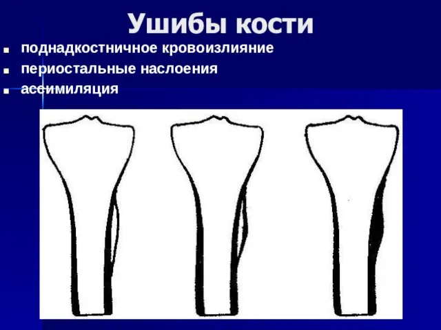 Ушибы кости поднадкостничное кровоизлияние периостальные наслоения ассимиляция