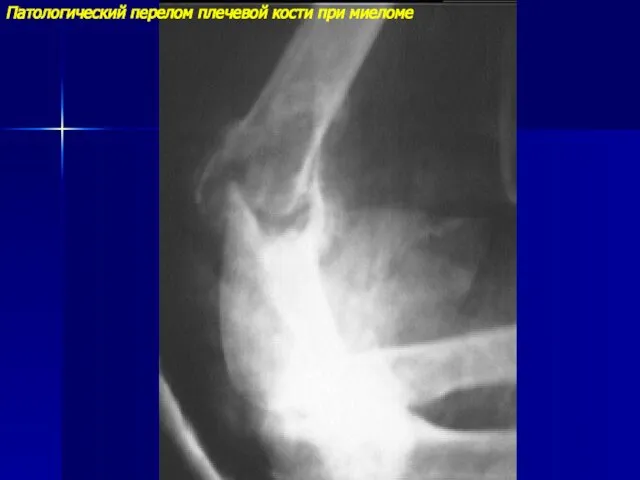 Патологический перелом плечевой кости при миеломе