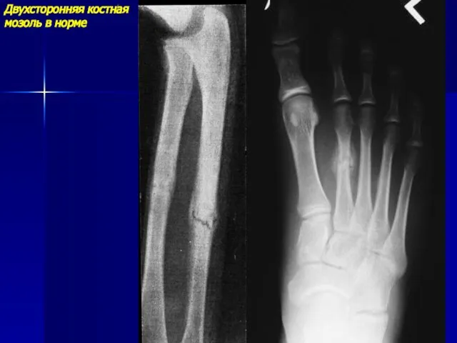 Двухсторонняя костная мозоль в норме