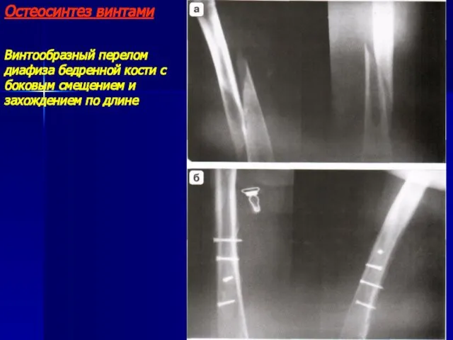Остеосинтез винтами Винтообразный перелом диафиза бедренной кости с боковым смещением и захождением по длине