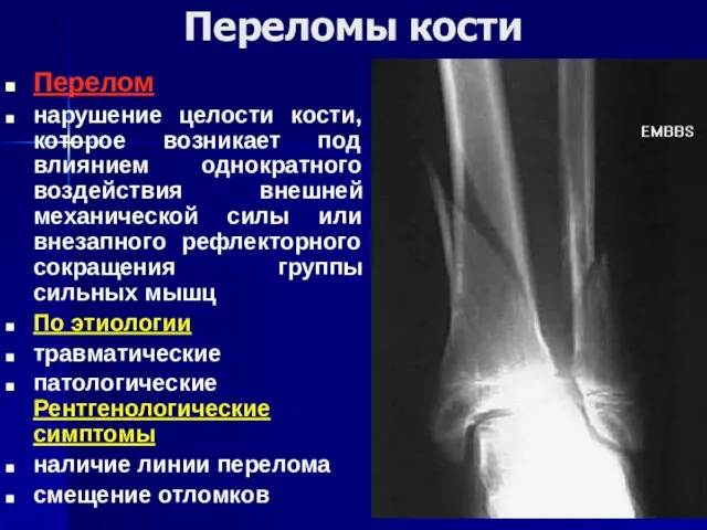 Переломы кости Перелом нарушение целости кости, которое возникает под влиянием однократного