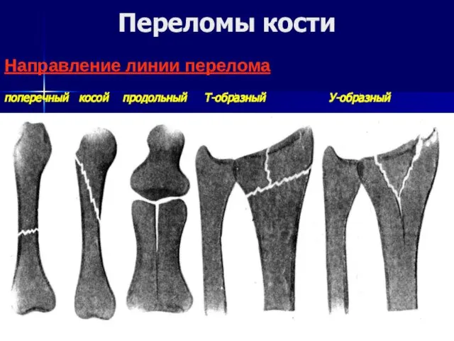 Направление линии перелома поперечный косой продольный Т-образный У-образный Переломы кости