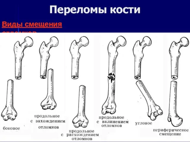 Виды смещения отломков Переломы кости