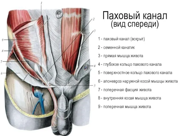 1 - паховый канал (вскрыт) 2 - семенной канатик 3 -