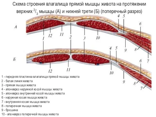 1 - передняя пластинка влагалища прямой мышцы живота 2 - белая