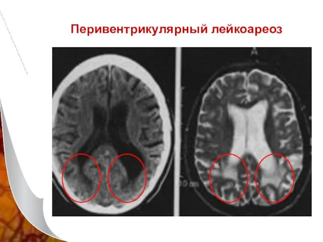 Перивентрикулярный лейкоареоз