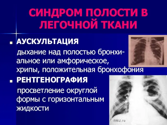 СИНДРОМ ПОЛОСТИ В ЛЕГОЧНОЙ ТКАНИ АУСКУЛЬТАЦИЯ дыхание над полостью бронхи- альное