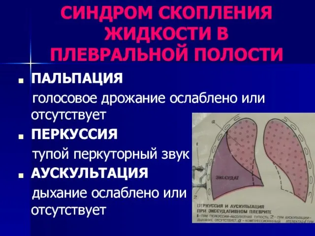 СИНДРОМ СКОПЛЕНИЯ ЖИДКОСТИ В ПЛЕВРАЛЬНОЙ ПОЛОСТИ ПАЛЬПАЦИЯ голосовое дрожание ослаблено или