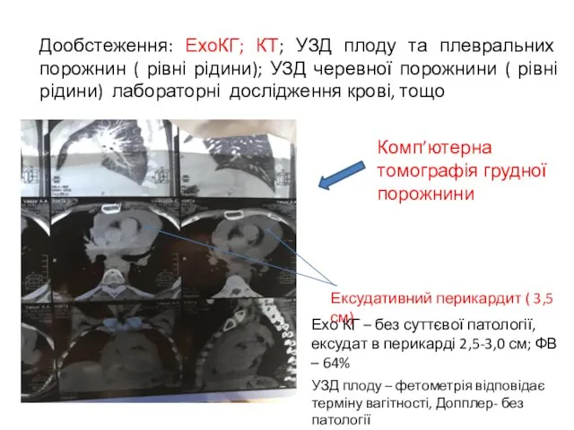 Дообстеження: ЕхоКГ; КТ; УЗД плоду та плевральних порожнин ( рівні рідини);