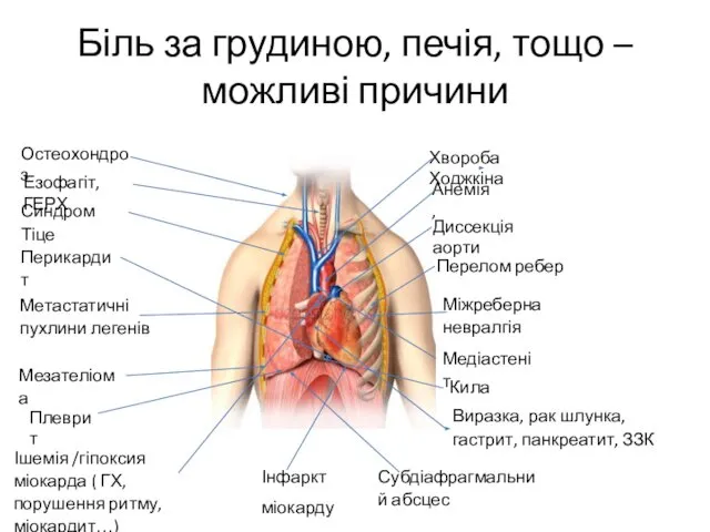 Біль за грудиною, печія, тощо – можливі причини Перелом ребер Остеохондроз