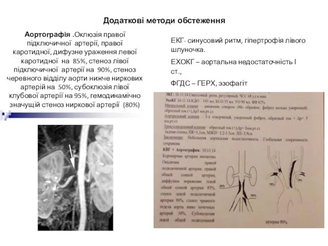 Аортографія .Оклюзія правої підключичної артерії, правої каротидної, дифузне ураження левої каротидної