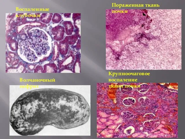 Пораженная ткань почки Воспаленные клубочки Крупноочаговое воспаление ткани почки Волчаночный нефрит