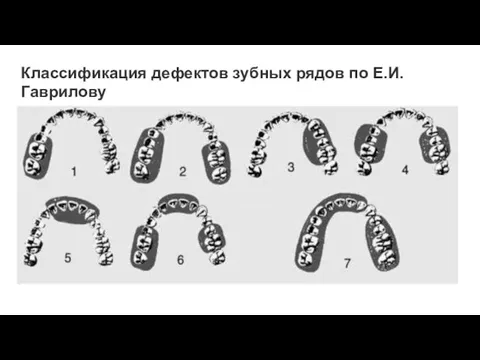 Классификация дефектов зубных рядов по Е.И. Гаврилову
