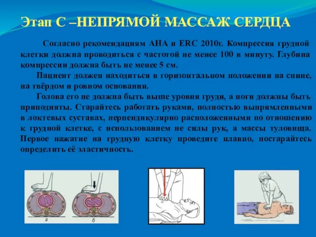 Этап С –НЕПРЯМОЙ МАССАЖ СЕРДЦА Согласно рекомендациям AHA и ERC 2010г.