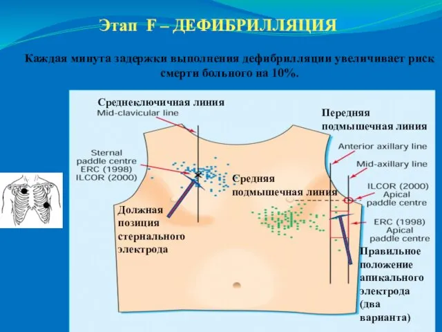 Этап F – ДЕФИБРИЛЛЯЦИЯ Передняя подмышечная линия Правильное положение апикального электрода