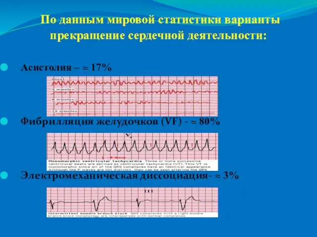 По данным мировой статистики варианты прекращение сердечной деятельности: Асистолия – ≈