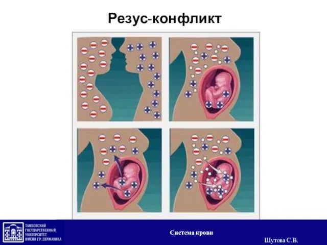 Резус-конфликт Система крови Шутова С.В.