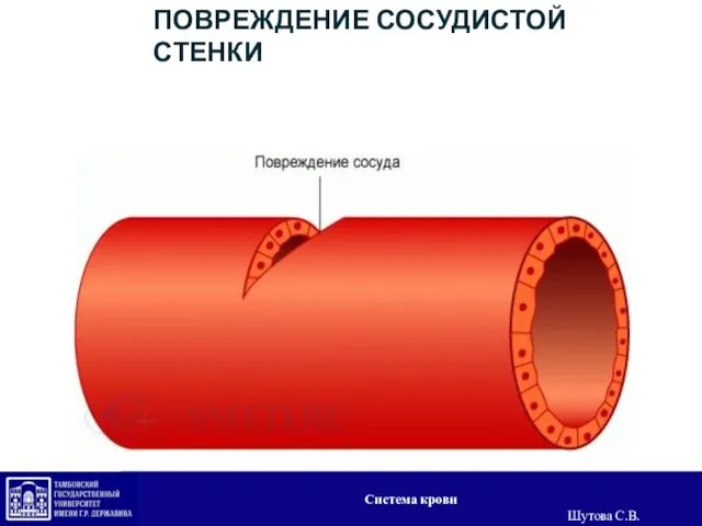 ПОВРЕЖДЕНИЕ СОСУДИСТОЙ СТЕНКИ Система крови Шутова С.В.