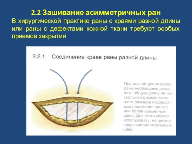 2.2 Зашивание асимметричных ран В хирургической практике раны с краями разной