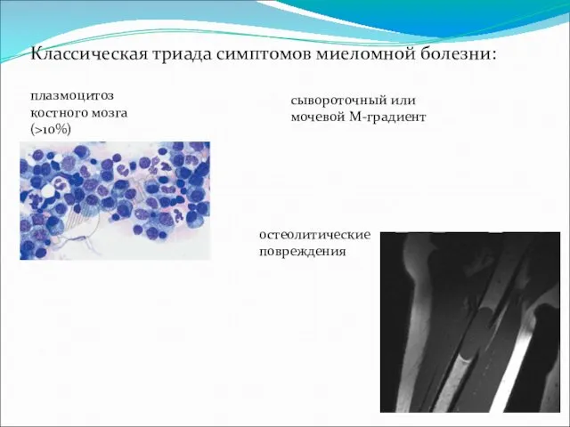 Классическая триада симптомов миеломной болезни: плазмоцитоз костного мозга (>10%) сывороточный или мочевой М-градиент остеолитические повреждения