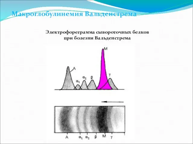 Макроглобулинемия Вальденстрема Электрофореграмма сывороточных белков при болезни Вальденстрема