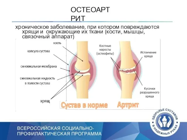 ОСТЕОАРТРИТ хроническое заболевание, при котором повреждаются хрящи и окружающие их ткани (кости, мышцы, связочный аппарат)