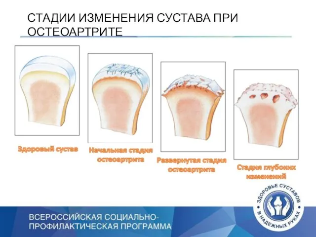 СТАДИИ ИЗМЕНЕНИЯ СУСТАВА ПРИ ОСТЕОАРТРИТЕ