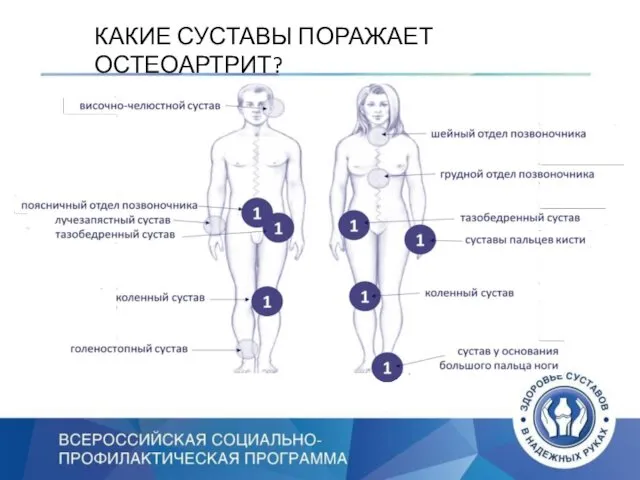 КАКИЕ СУСТАВЫ ПОРАЖАЕТ ОСТЕОАРТРИТ?