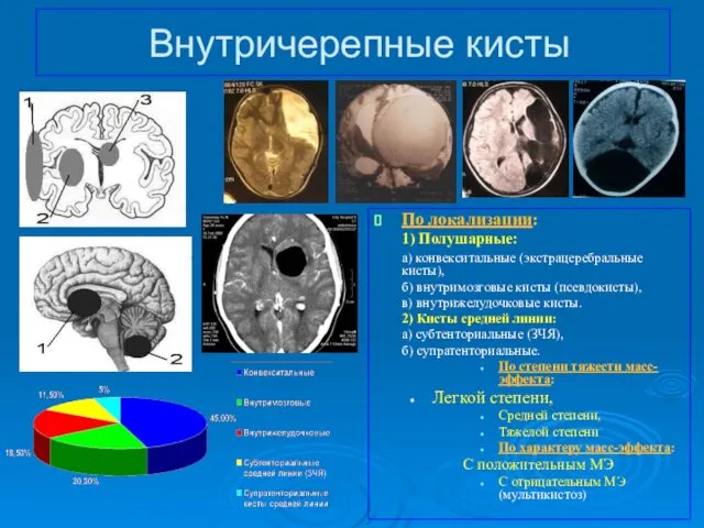 Внутричерепные кисты По локализации: 1) Полушарные: а) конвекситальные (экстрацеребральные кисты), б)