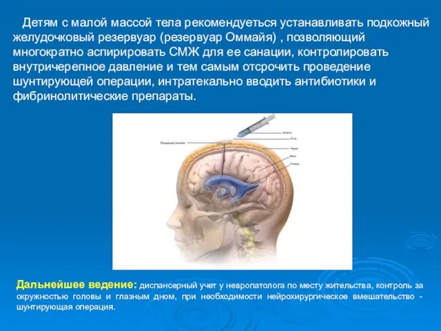 Детям с малой массой тела рекомендуеться устанавливать подкожный желудочковый резервуар (резервуар