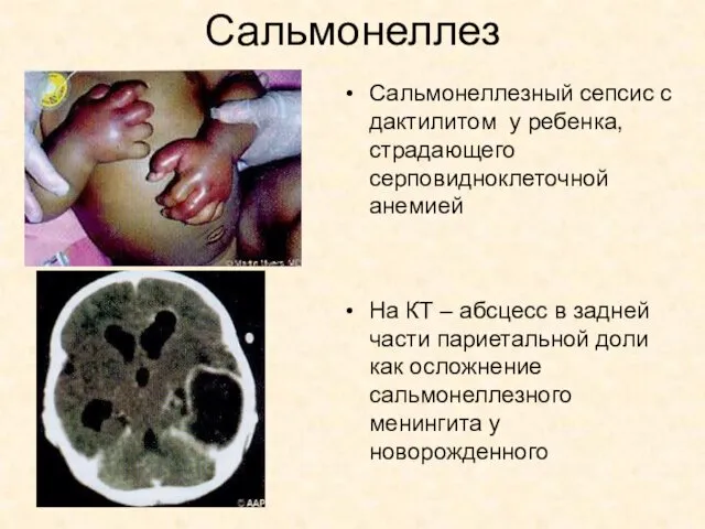 Сальмонеллез Сальмонеллезный сепсис с дактилитом у ребенка, страдающего серповидноклеточной анемией На