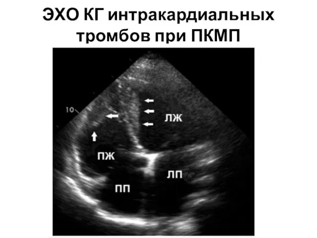 ЭХО КГ интракардиальных тромбов при ПКМП