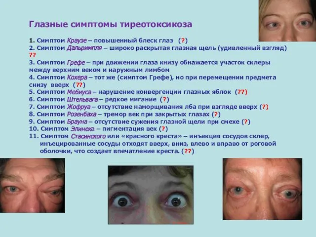 Глазные симптомы тиреотоксикоза 1. Симптом Краузе – повышенный блеск глаз (?)
