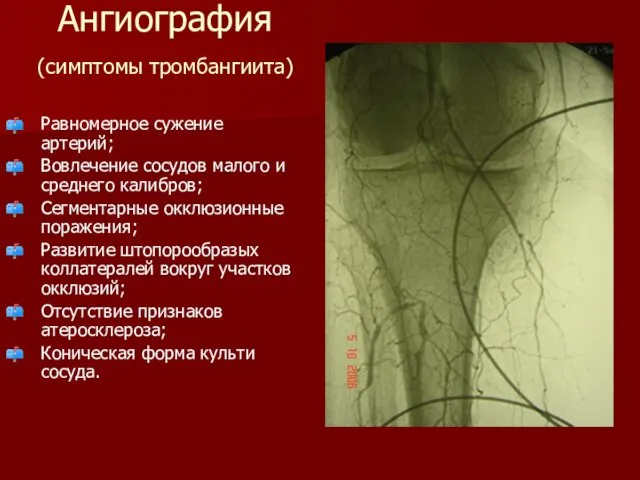 Ангиография (симптомы тромбангиита) Равномерное сужение артерий; Вовлечение сосудов малого и среднего