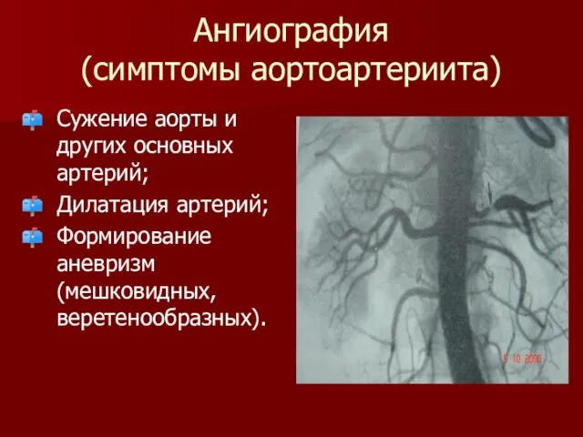 Ангиография (симптомы аортоартериита) Сужение аорты и других основных артерий; Дилатация артерий; Формирование аневризм (мешковидных, веретенообразных).