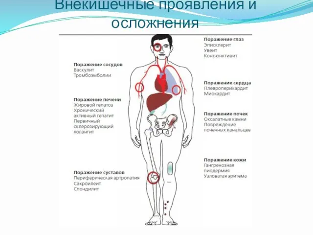 Внекишечные проявления и осложнения