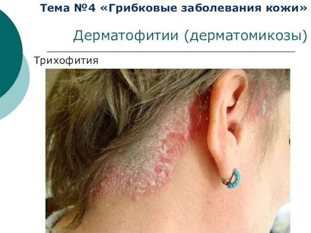 Тема №4 «Грибковые заболевания кожи» Дерматофитии (дерматомикозы) Трихофития