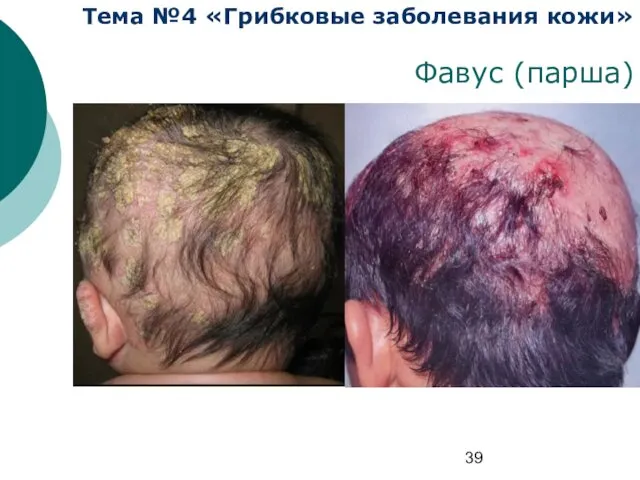 Тема №4 «Грибковые заболевания кожи» Фавус (парша)
