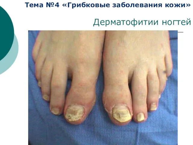 Тема №4 «Грибковые заболевания кожи» Дерматофитии ногтей