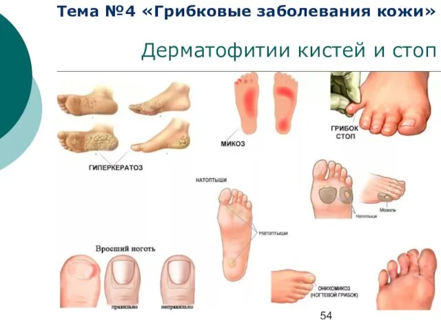 Тема №4 «Грибковые заболевания кожи» Дерматофитии кистей и стоп