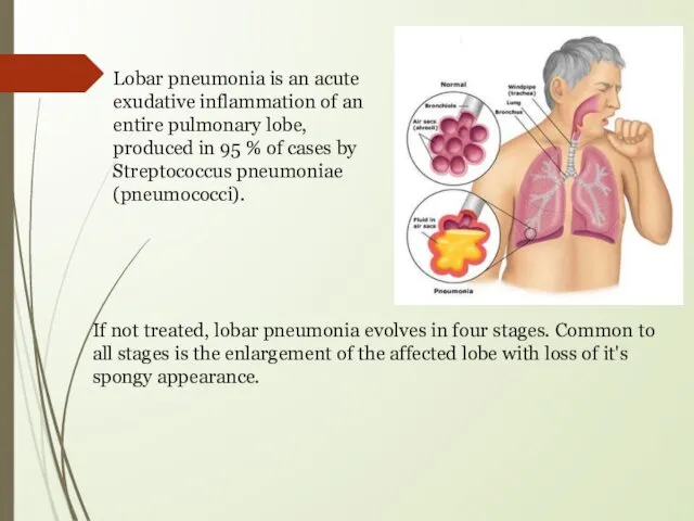 Lobar pneumonia is an acute exudative inflammation of an entire pulmonary