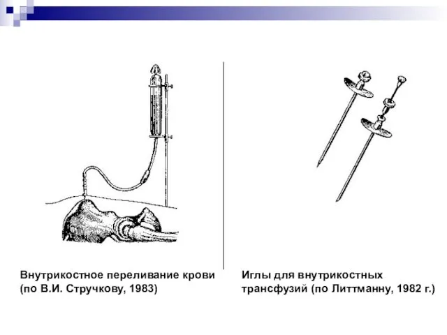 Внутрикостное переливание крови (по В.И. Стручкову, 1983) Иглы для внутрикостных трансфузий (по Литтманну, 1982 г.)